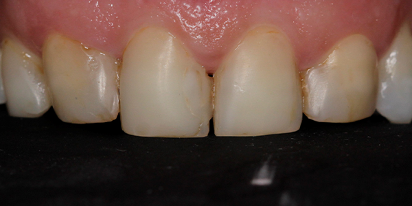 Before